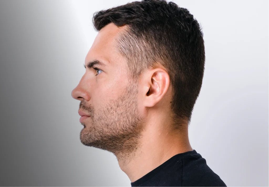 Chin Filler for Men in Boston, MA Banner