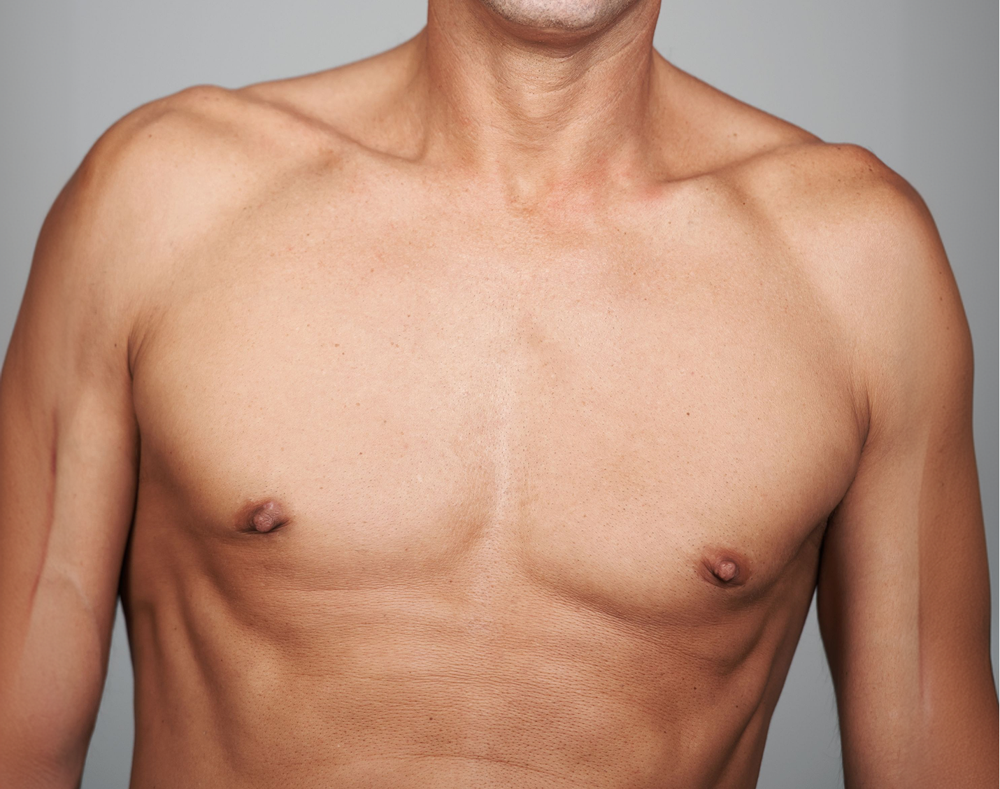 Can Gynecomastia Go Away on Its Own? Banner